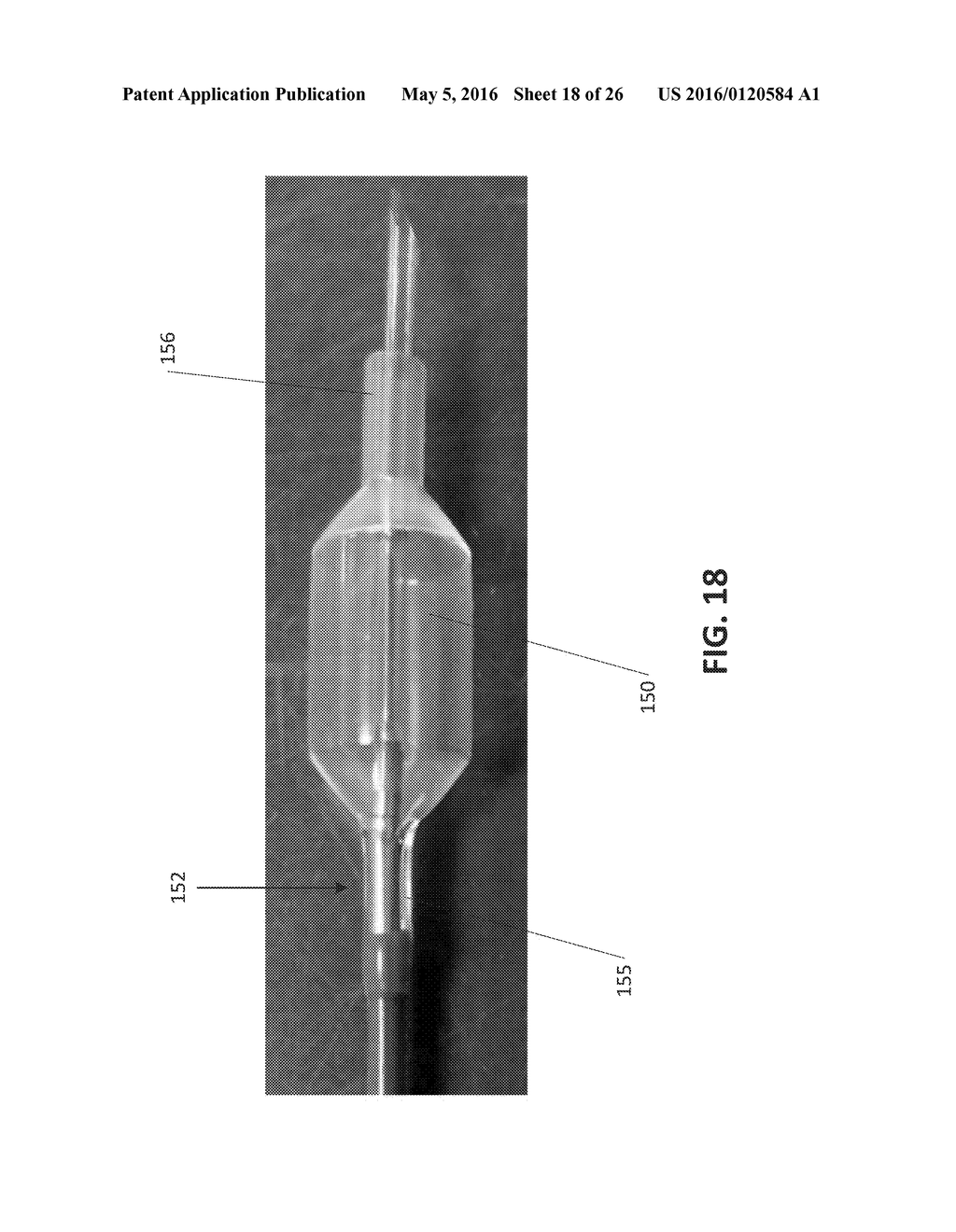 CATHETER DEVICE WITH LONGITUDINALLY EXPANDING INTERIOR COMPONENTS FOR     COMPRESSING CANCELLOUS BONE - diagram, schematic, and image 19