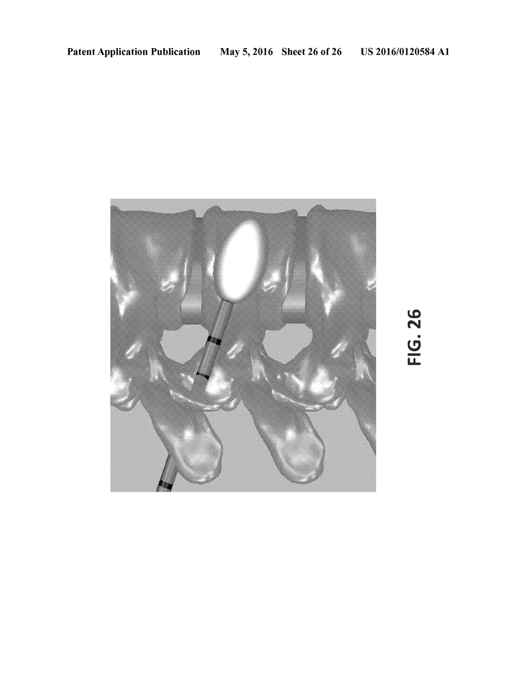 CATHETER DEVICE WITH LONGITUDINALLY EXPANDING INTERIOR COMPONENTS FOR     COMPRESSING CANCELLOUS BONE - diagram, schematic, and image 27