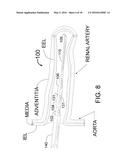 TRANSVASCULAR METHODS OF TREATING EXTRAVASCULAR TISSUE diagram and image