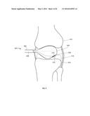 THERMALLY TREATING TORN TISSUE diagram and image