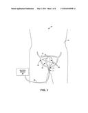 ABLATION THERAPY TO DISRUPT COORDINATED BLADDER CONTRACTIONS diagram and image