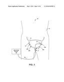 ABLATION THERAPY TO DISRUPT COORDINATED BLADDER CONTRACTIONS diagram and image