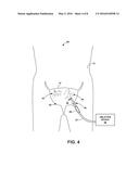 ABLATION THERAPY TO DISRUPT COORDINATED BLADDER CONTRACTIONS diagram and image