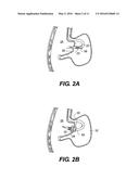 METHODS AND DEVICES FOR CREATING AN OPENING THROUGH AN ANATOMIC WALL diagram and image