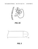 METHODS AND DEVICES FOR CREATING AN OPENING THROUGH AN ANATOMIC WALL diagram and image