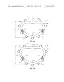 HEART AND PERIPHERAL VASCULAR VALVE REPLACEMENT IN CONJUNCTION WITH A     SUPPORT RING diagram and image