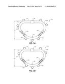 HEART AND PERIPHERAL VASCULAR VALVE REPLACEMENT IN CONJUNCTION WITH A     SUPPORT RING diagram and image