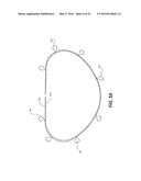 HEART AND PERIPHERAL VASCULAR VALVE REPLACEMENT IN CONJUNCTION WITH A     SUPPORT RING diagram and image