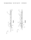 HEART AND PERIPHERAL VASCULAR VALVE REPLACEMENT IN CONJUNCTION WITH A     SUPPORT RING diagram and image