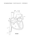 HEART AND PERIPHERAL VASCULAR VALVE REPLACEMENT IN CONJUNCTION WITH A     SUPPORT RING diagram and image