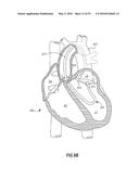 HEART AND PERIPHERAL VASCULAR VALVE REPLACEMENT IN CONJUNCTION WITH A     SUPPORT RING diagram and image