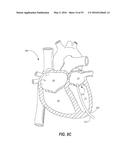 HEART AND PERIPHERAL VASCULAR VALVE REPLACEMENT IN CONJUNCTION WITH A     SUPPORT RING diagram and image