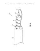 HEART AND PERIPHERAL VASCULAR VALVE REPLACEMENT IN CONJUNCTION WITH A     SUPPORT RING diagram and image