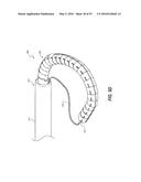 HEART AND PERIPHERAL VASCULAR VALVE REPLACEMENT IN CONJUNCTION WITH A     SUPPORT RING diagram and image