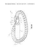 HEART AND PERIPHERAL VASCULAR VALVE REPLACEMENT IN CONJUNCTION WITH A     SUPPORT RING diagram and image