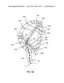 HEART AND PERIPHERAL VASCULAR VALVE REPLACEMENT IN CONJUNCTION WITH A     SUPPORT RING diagram and image