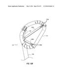 HEART AND PERIPHERAL VASCULAR VALVE REPLACEMENT IN CONJUNCTION WITH A     SUPPORT RING diagram and image