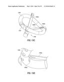 HEART AND PERIPHERAL VASCULAR VALVE REPLACEMENT IN CONJUNCTION WITH A     SUPPORT RING diagram and image