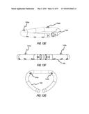 HEART AND PERIPHERAL VASCULAR VALVE REPLACEMENT IN CONJUNCTION WITH A     SUPPORT RING diagram and image