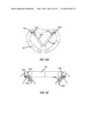 HEART AND PERIPHERAL VASCULAR VALVE REPLACEMENT IN CONJUNCTION WITH A     SUPPORT RING diagram and image