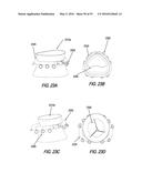 HEART AND PERIPHERAL VASCULAR VALVE REPLACEMENT IN CONJUNCTION WITH A     SUPPORT RING diagram and image