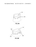 HEART AND PERIPHERAL VASCULAR VALVE REPLACEMENT IN CONJUNCTION WITH A     SUPPORT RING diagram and image