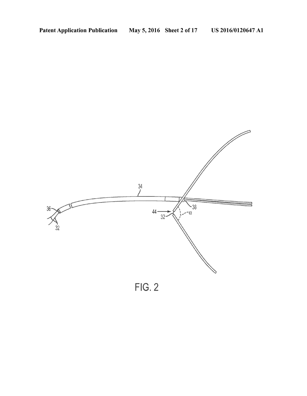 ENCIRCLING IMPLANT DELIVERY SYSTEMS AND METHODS - diagram, schematic, and image 03