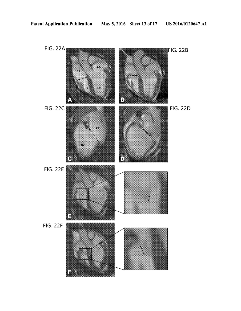 ENCIRCLING IMPLANT DELIVERY SYSTEMS AND METHODS - diagram, schematic, and image 14