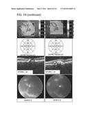 USE OF PEDF IN AN ENCAPSULATED CELL-BASED DELIVERY SYSTEM diagram and image