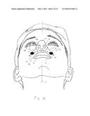 PATIENT INTERFACE DEVICE WITH LIMITED SUPPORT AREA ON THE FACE diagram and image