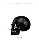 PATIENT INTERFACE DEVICE WITH LIMITED SUPPORT AREA ON THE FACE diagram and image