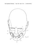 PATIENT INTERFACE DEVICE WITH LIMITED SUPPORT AREA ON THE FACE diagram and image