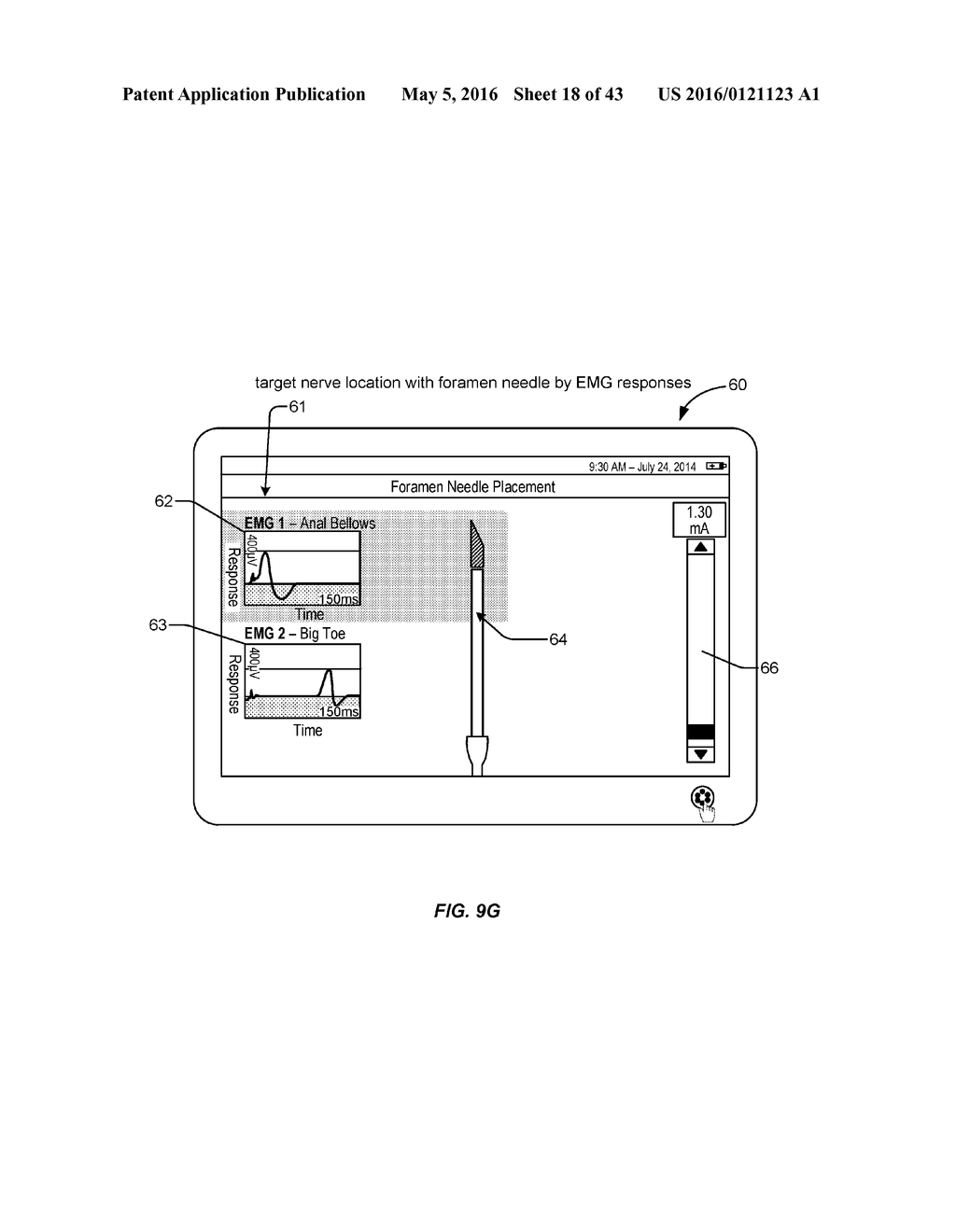 Electromyographic Lead Positioning and Stimulation Titration in a Nerve     Stimulation System for Treatment of Overactive Bladder - diagram, schematic, and image 19