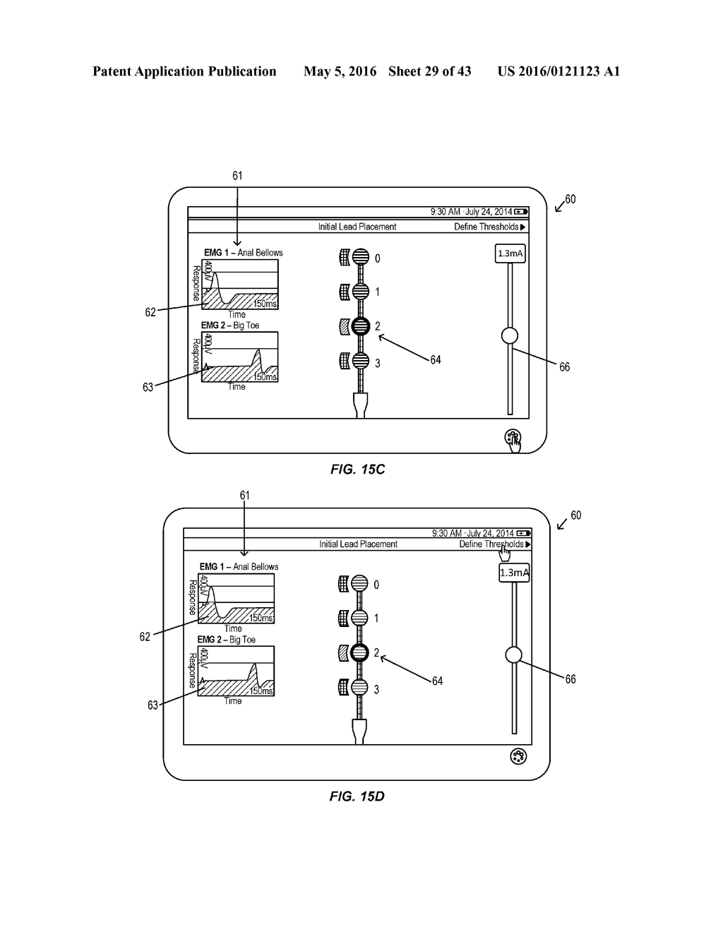 Electromyographic Lead Positioning and Stimulation Titration in a Nerve     Stimulation System for Treatment of Overactive Bladder - diagram, schematic, and image 30