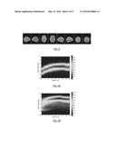 AMYLOID PET BRAIN SCAN QUANTIFICATION BASED ON CORTICAL PROFILES diagram and image