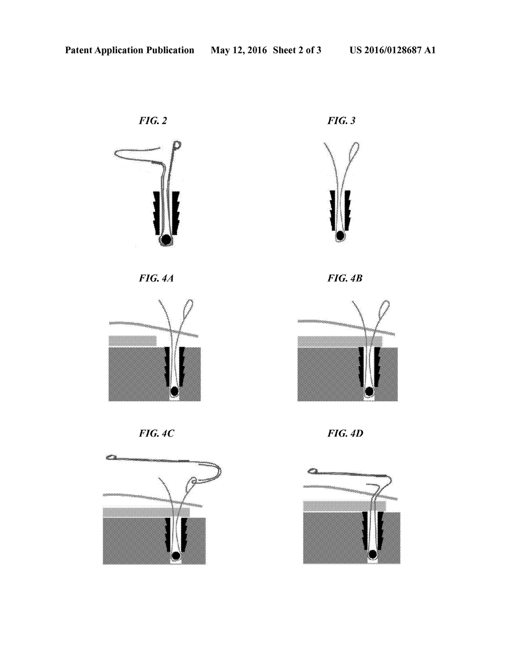 SURGICAL CONSTRUCTS AND METHODS FOR SECURING TISSUE - diagram, schematic, and image 03