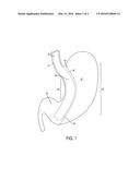 GASTRIC TRACTION DEVICE AND METHOD diagram and image