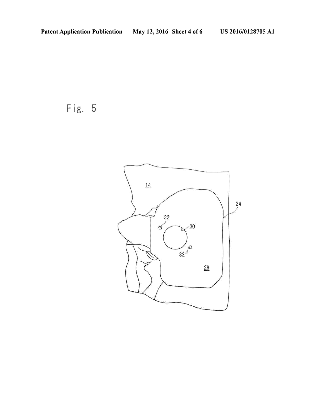 SURGICAL JIG, VERIFICATION JIG, AND METHODS FOR PRODUCING THESE JIGS - diagram, schematic, and image 05