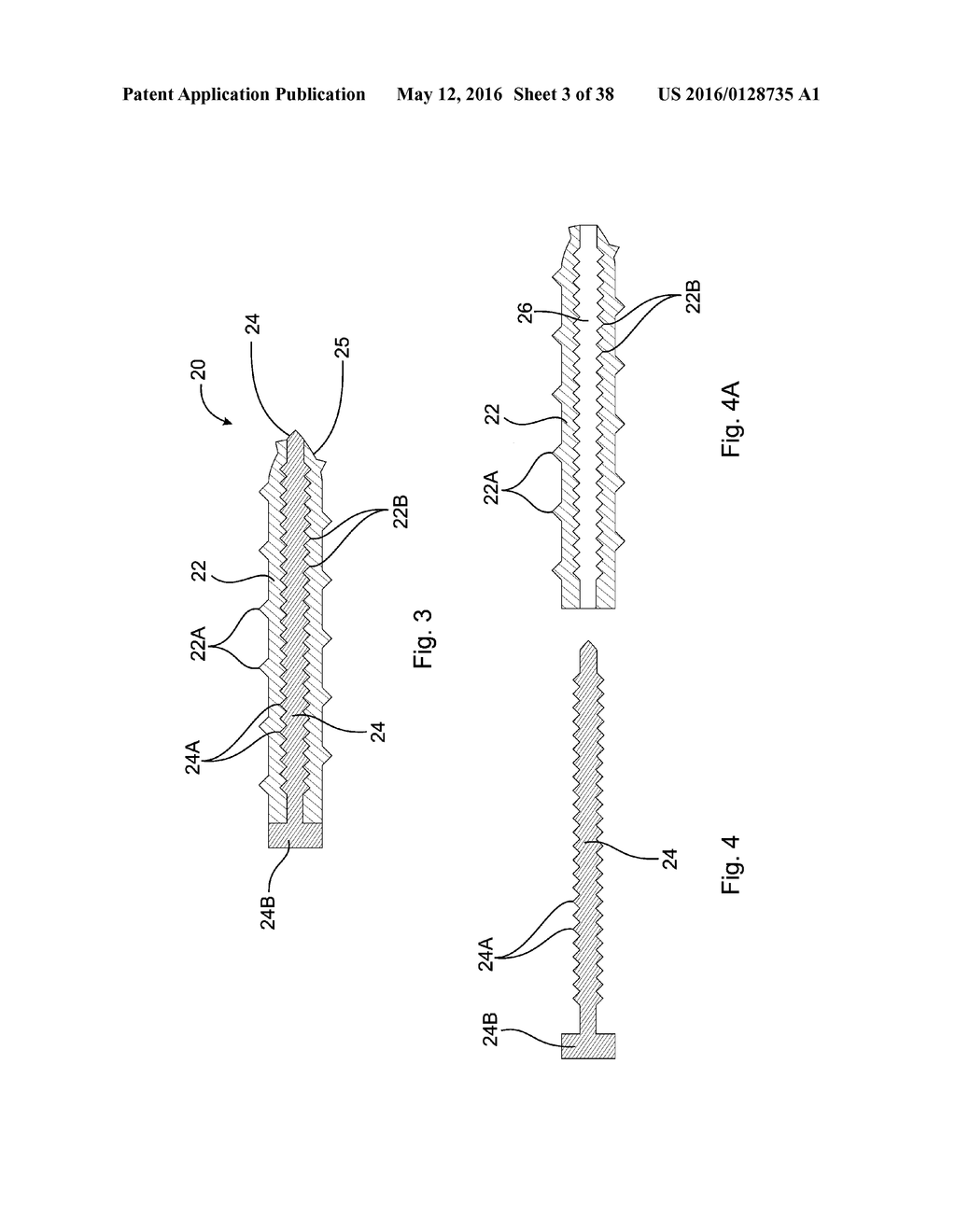 SUBCUTANEOUS IMPLANTABLE DEVICE FOR GRADUALLY ALIGNING A SPINE AND     SUBCUTANEOUS IMPLANTABLE DEVICE FOR GRADUALLY LENGTHENING A BONE - diagram, schematic, and image 04