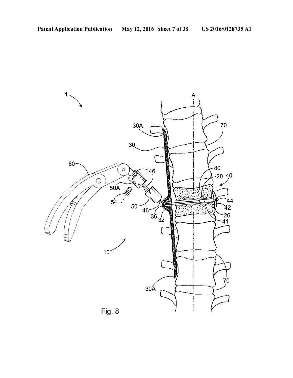 SUBCUTANEOUS IMPLANTABLE DEVICE FOR GRADUALLY ALIGNING A SPINE AND     SUBCUTANEOUS IMPLANTABLE DEVICE FOR GRADUALLY LENGTHENING A BONE - diagram, schematic, and image 08