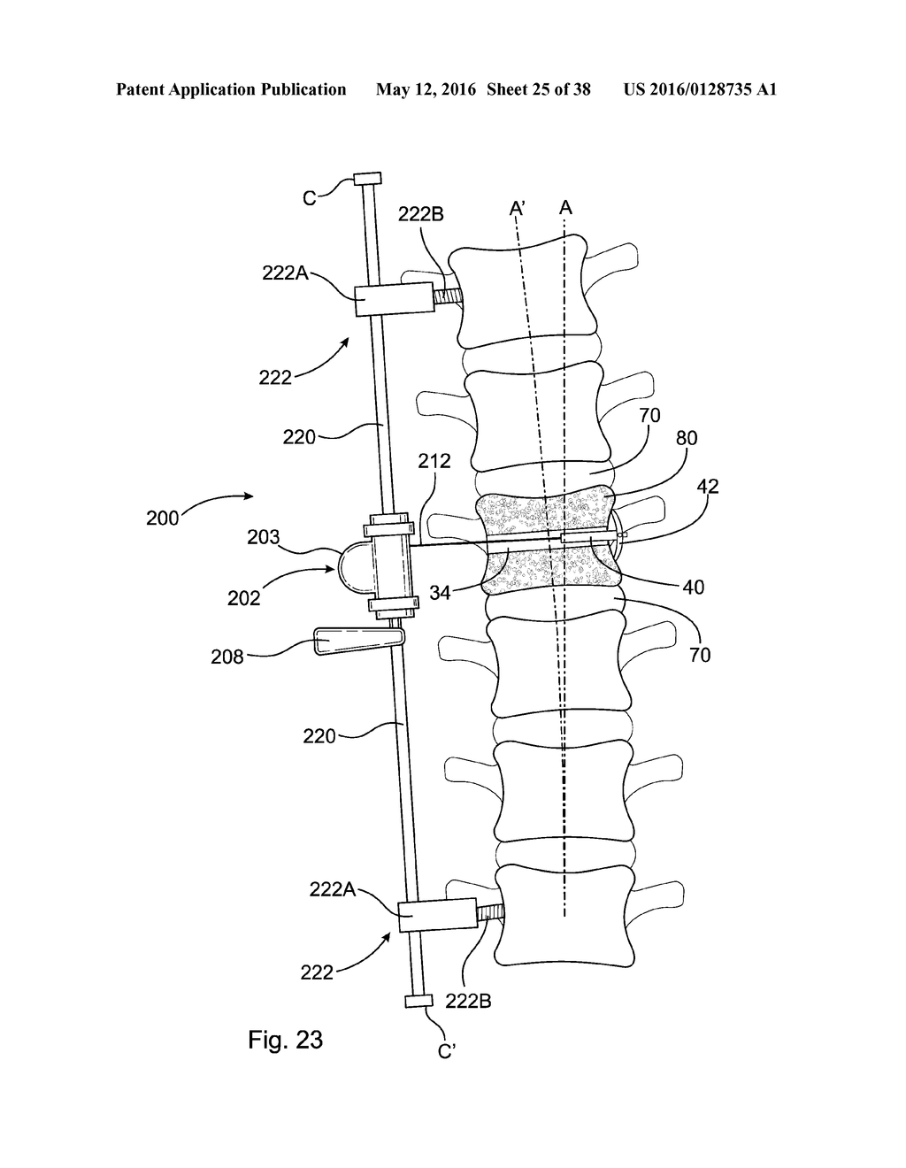 SUBCUTANEOUS IMPLANTABLE DEVICE FOR GRADUALLY ALIGNING A SPINE AND     SUBCUTANEOUS IMPLANTABLE DEVICE FOR GRADUALLY LENGTHENING A BONE - diagram, schematic, and image 26