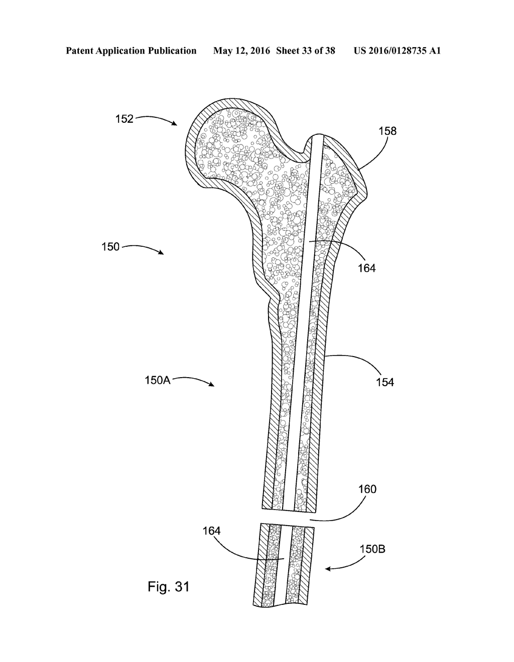 SUBCUTANEOUS IMPLANTABLE DEVICE FOR GRADUALLY ALIGNING A SPINE AND     SUBCUTANEOUS IMPLANTABLE DEVICE FOR GRADUALLY LENGTHENING A BONE - diagram, schematic, and image 34