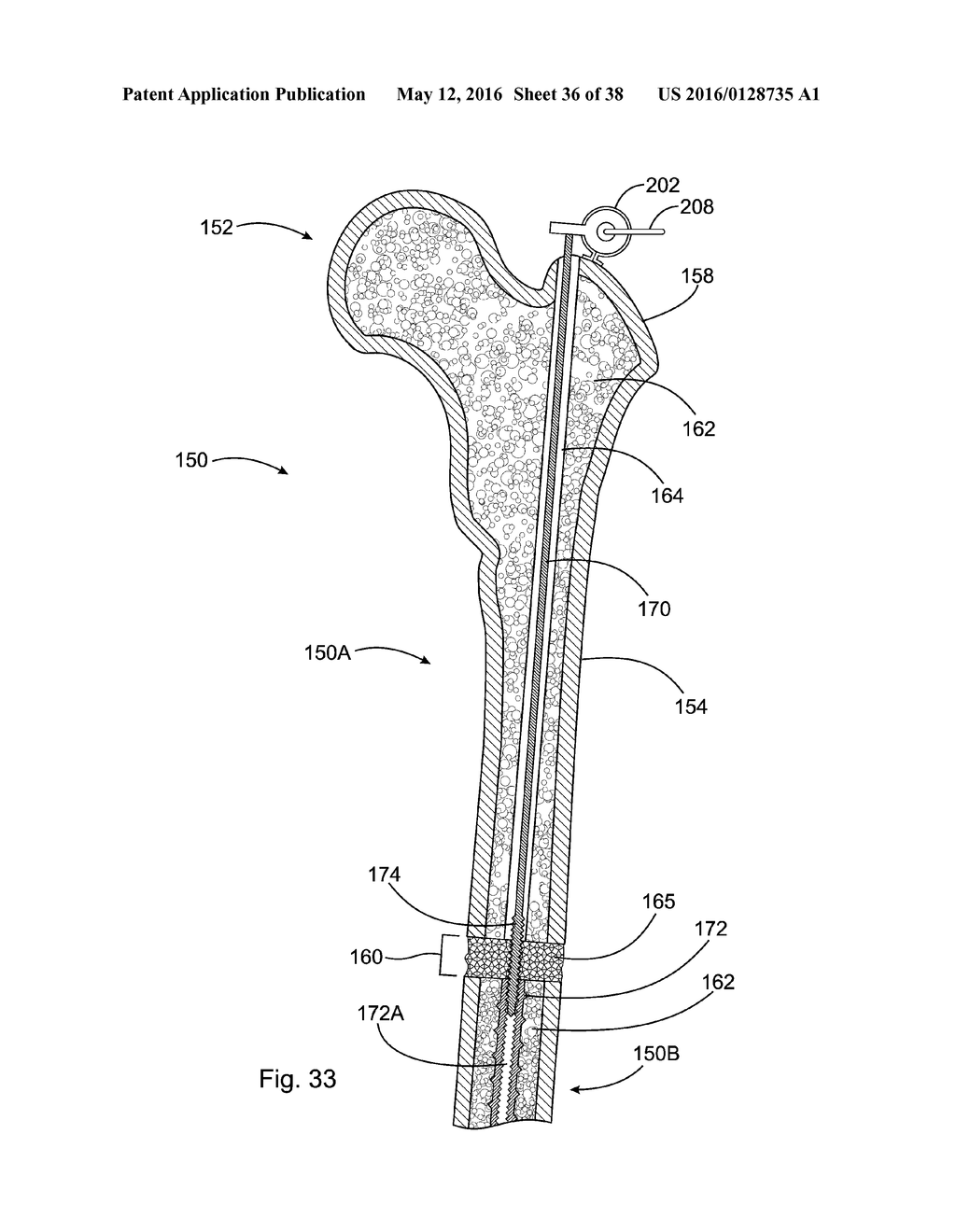 SUBCUTANEOUS IMPLANTABLE DEVICE FOR GRADUALLY ALIGNING A SPINE AND     SUBCUTANEOUS IMPLANTABLE DEVICE FOR GRADUALLY LENGTHENING A BONE - diagram, schematic, and image 37