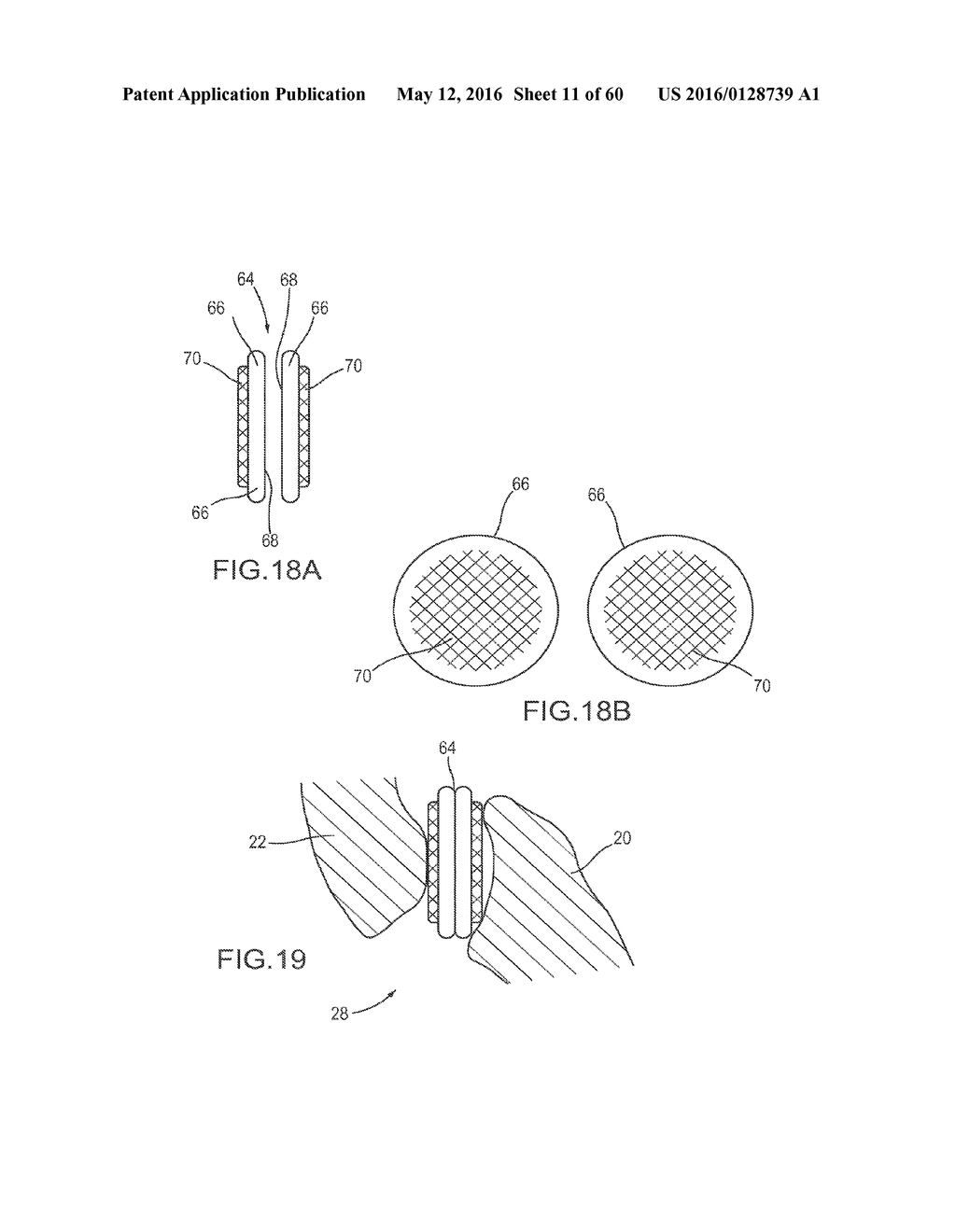 VERTEBRAL FACET JOINT FUSION IMPLANT AND METHOD FOR FUSION - diagram, schematic, and image 12