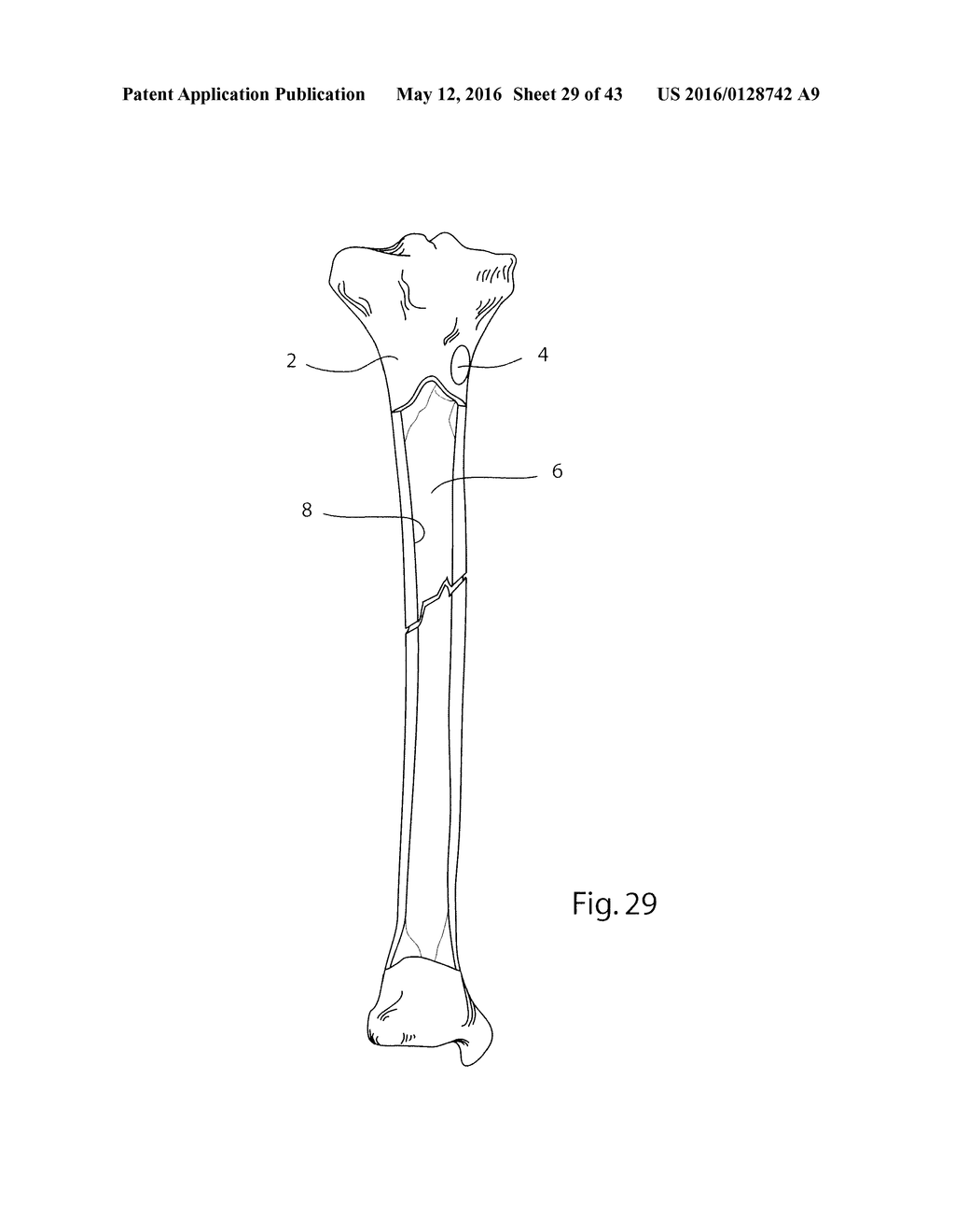 BONE STABILIZATION DEVICE AND METHOD - diagram, schematic, and image 30