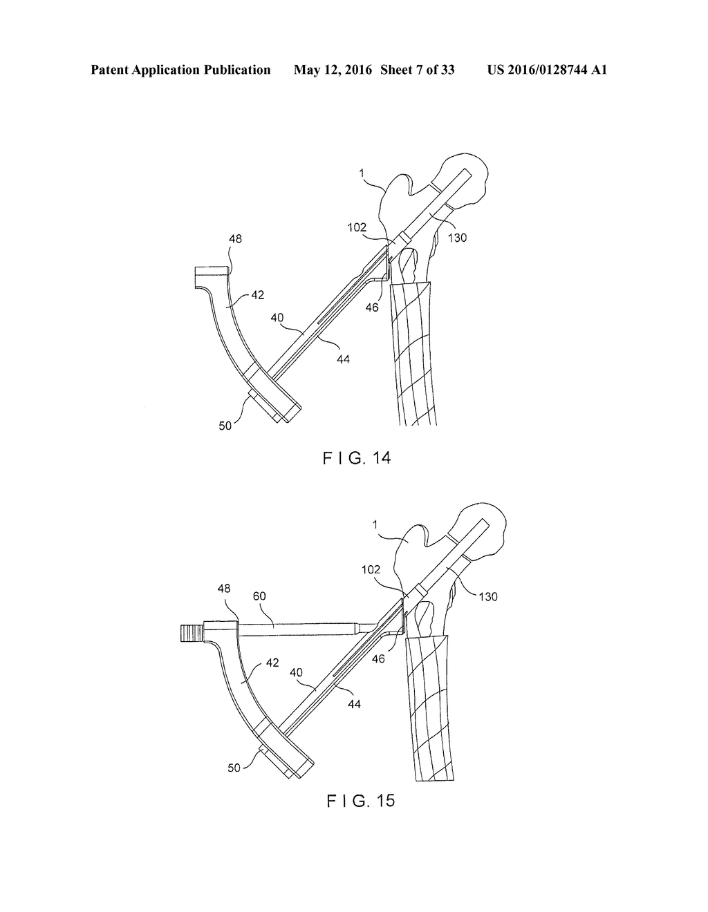 Femoral Neck Fracture Implant - diagram, schematic, and image 08