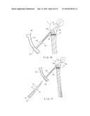 Femoral Neck Fracture Implant diagram and image