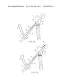 Femoral Neck Fracture Implant diagram and image