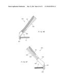 Femoral Neck Fracture Implant diagram and image