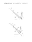 Femoral Neck Fracture Implant diagram and image